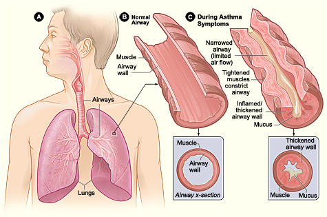  Prevent Asthma