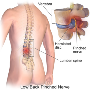 Lower Back Pain