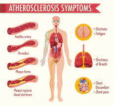 Understanding Atherosclerosis: Causes, Symptoms, and Prevention Strategies