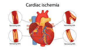 Living with ANGINA PECTORIS : Managing Chest Pain and Improving Heart Health