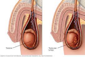 Testicular Cancer