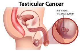 Testicular Cancer