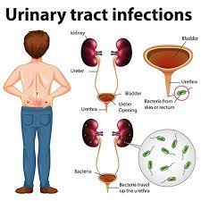 Urinary Tract Infections