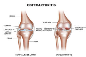 Managing Osteoarthritis: Tips for Reducing Joint Pain and Improving Mobility