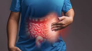 INFLAMMATORY BOWEL DISEASE