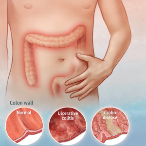 INFLAMMATORY BOWEL DISEASE