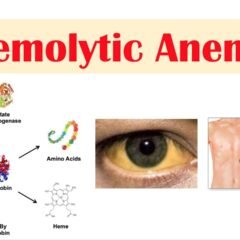 Acquired Hemolytic Anemia