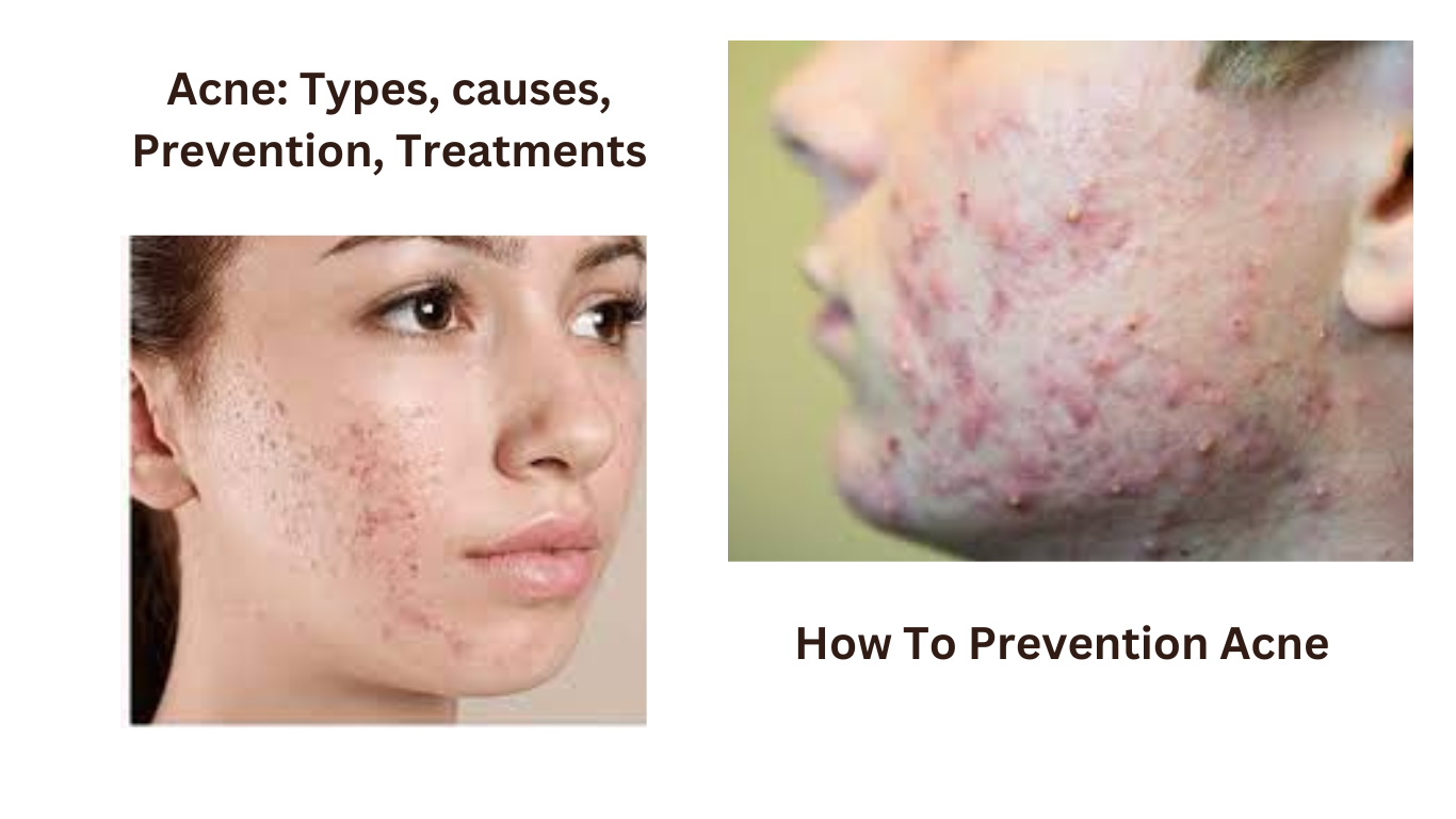 Acne : Types, causes, Prevention, Treatments - Medical Health Guide ...