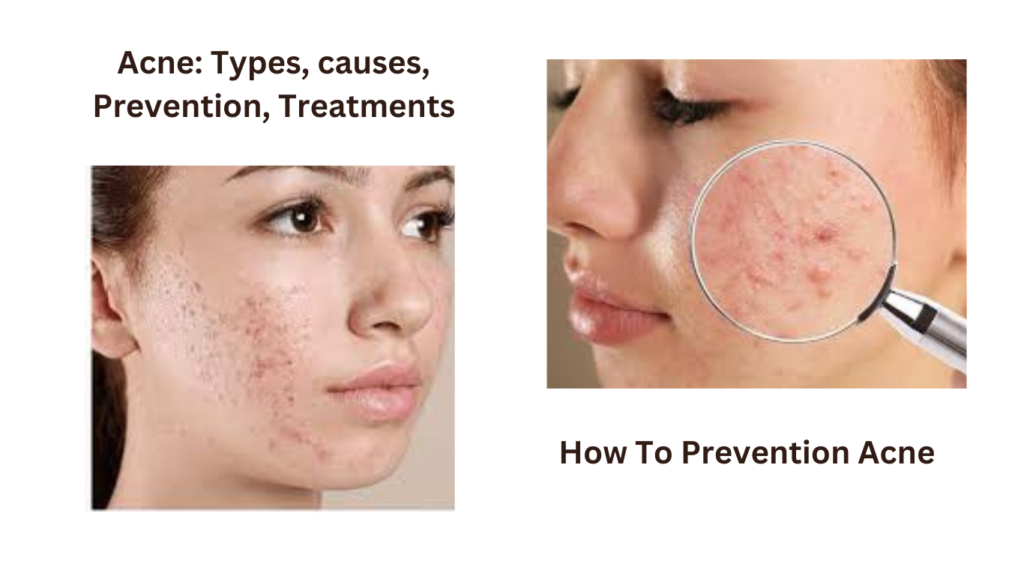 Acne Types Causes Prevention Treatments Medical Health Guide Best Treatments 2023 3497